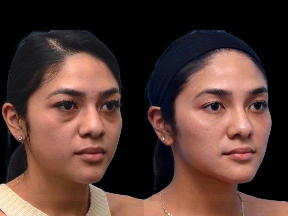 Before and After Dark Circles Treatment with Best Doctors in dubai