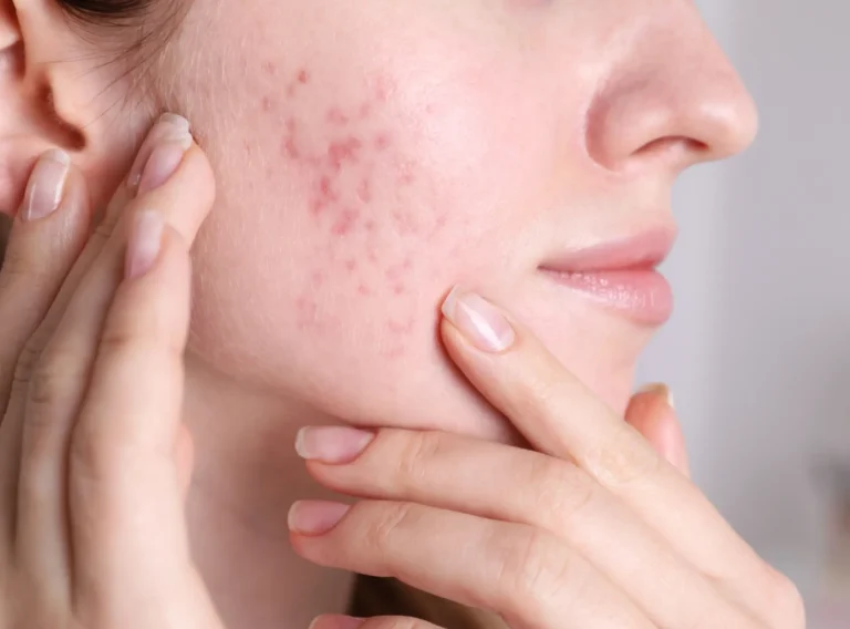 Expert Tips on Acne Treatment In Dubai for Healthy Skin