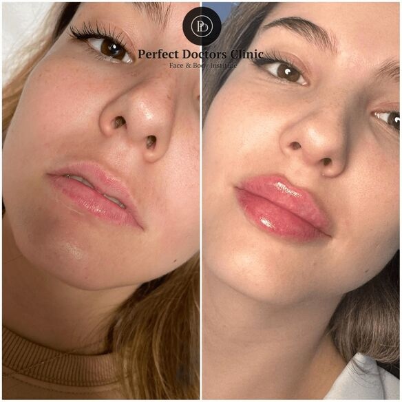 Juvederm for Lips by Best Doctors in dubai