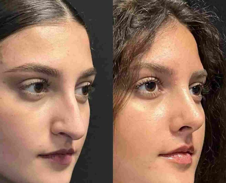 Rhinoplasty in Dubai: Innovative Techniques for Better Results