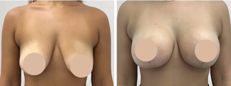 Breast Reduction in Dubai for a Balanced and Proportionate Figure