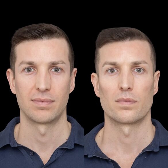 Achieve Sharp Jawlines with Fillers by Best Doctors in Dubai