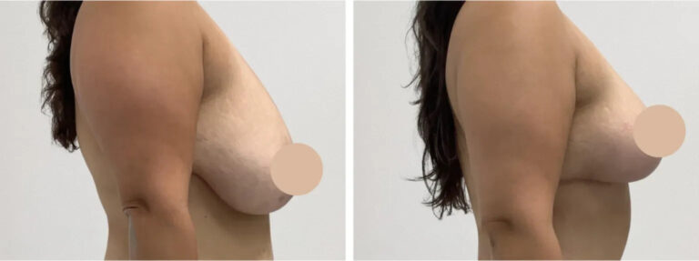 Professional Breast Lift in Dubai for Refined Results