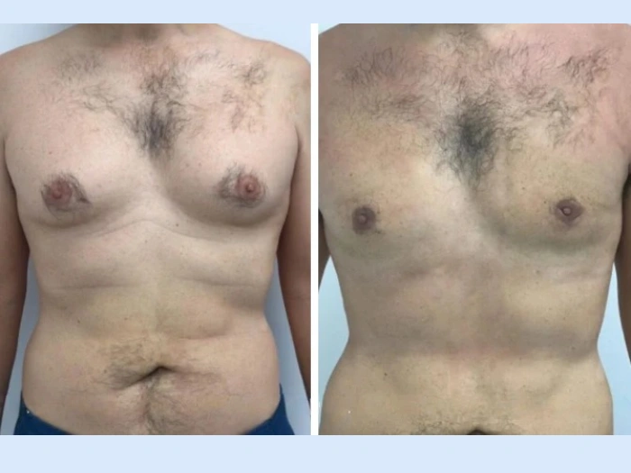 Understanding Gynecomastia Causes According to the Best Doctors in Dubai