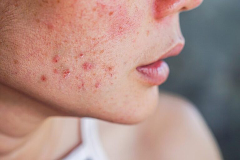 Acne Treatment in Dubai: Clear Skin Solutions for All Ages