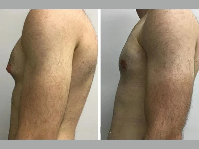 Gynecomastia Surgery in Dubai: Personalized Care for Men