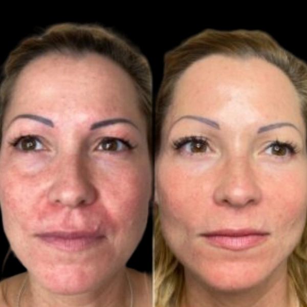 How Often Do Best Doctors in Dubai Recommend Profhilo?