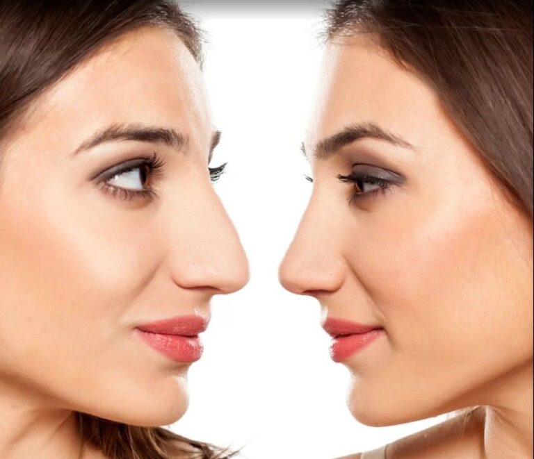 The Growing Popularity of Rhinoplasty in Dubai