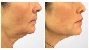 Best Doctors in Dubai Deliver Thread Lift Solutions for Subtle, Long-Lasting Facial Results