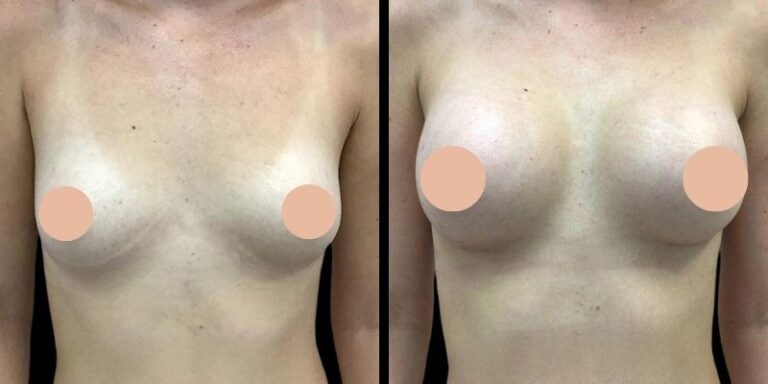 Breast Augmentation in Dubai: Natural-Looking Results vs Dramatic Transformations
