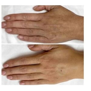 CO2 Hand Rejuvenation treatment reducing visible veins on aging hands