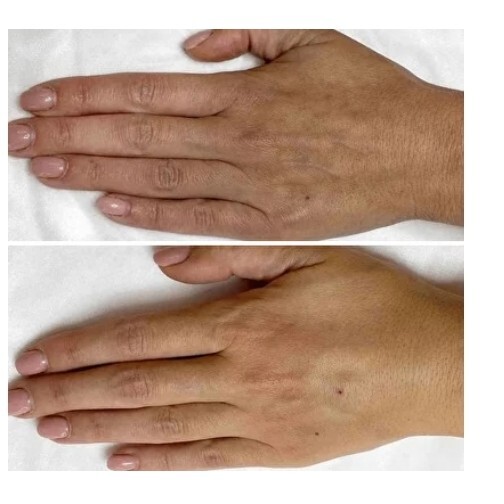 CO2 Hand Rejuvenation for Visible Veins