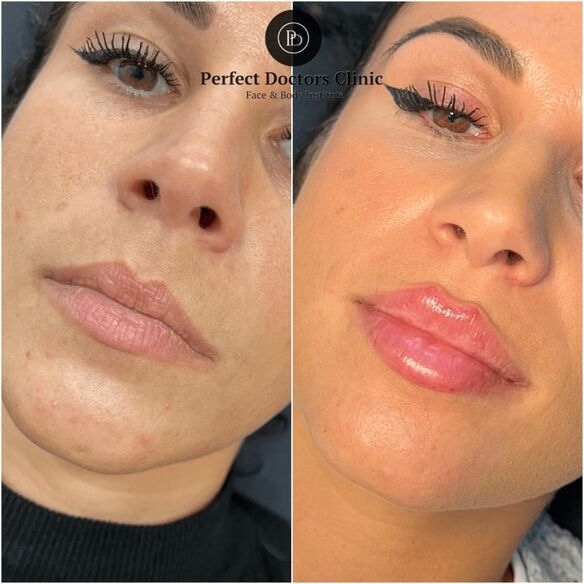 Juvederm vs Radiesse: What the Best Plastic Surgeons in Dubai Suggest