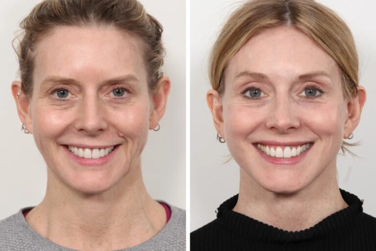 Why Thread Lift is Safer with the Best Doctors in dubai