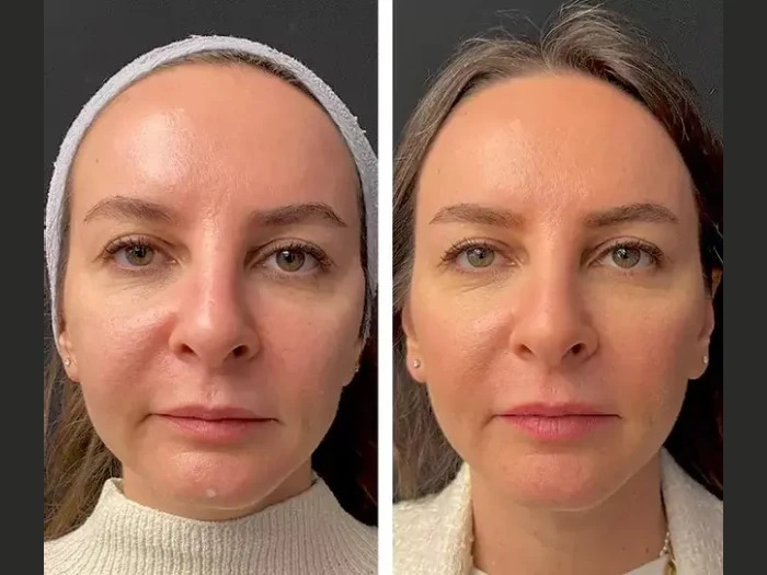 Best Doctors in Dubai for Mesotherapy Treatment: Expert Tips for Faster Healing