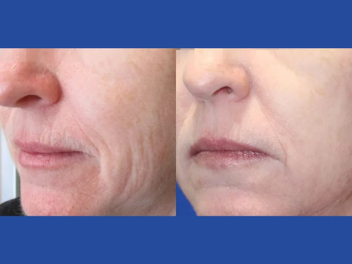 Fractional Radiofrequency (RF) Microneedling Treatments in Dubai for Visible Anti-Aging Results