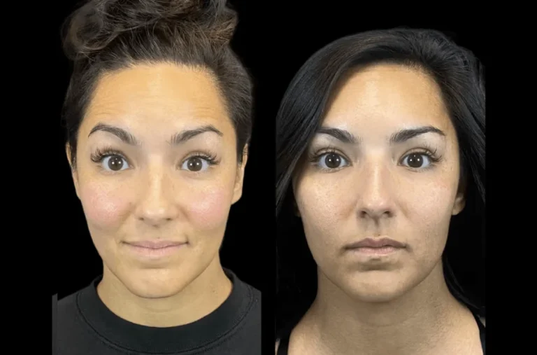 The Growing Demand for Botox in Dubai Among Beauty Enthusiasts